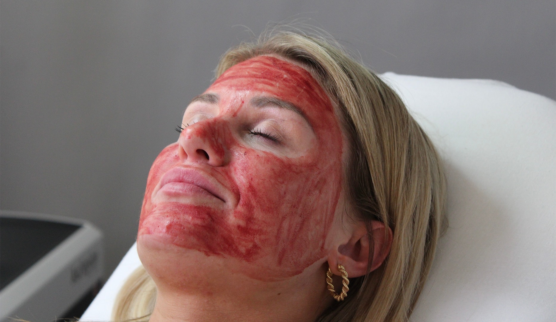 Vampire Facial Kombi-behandling med Microneedling og PRF