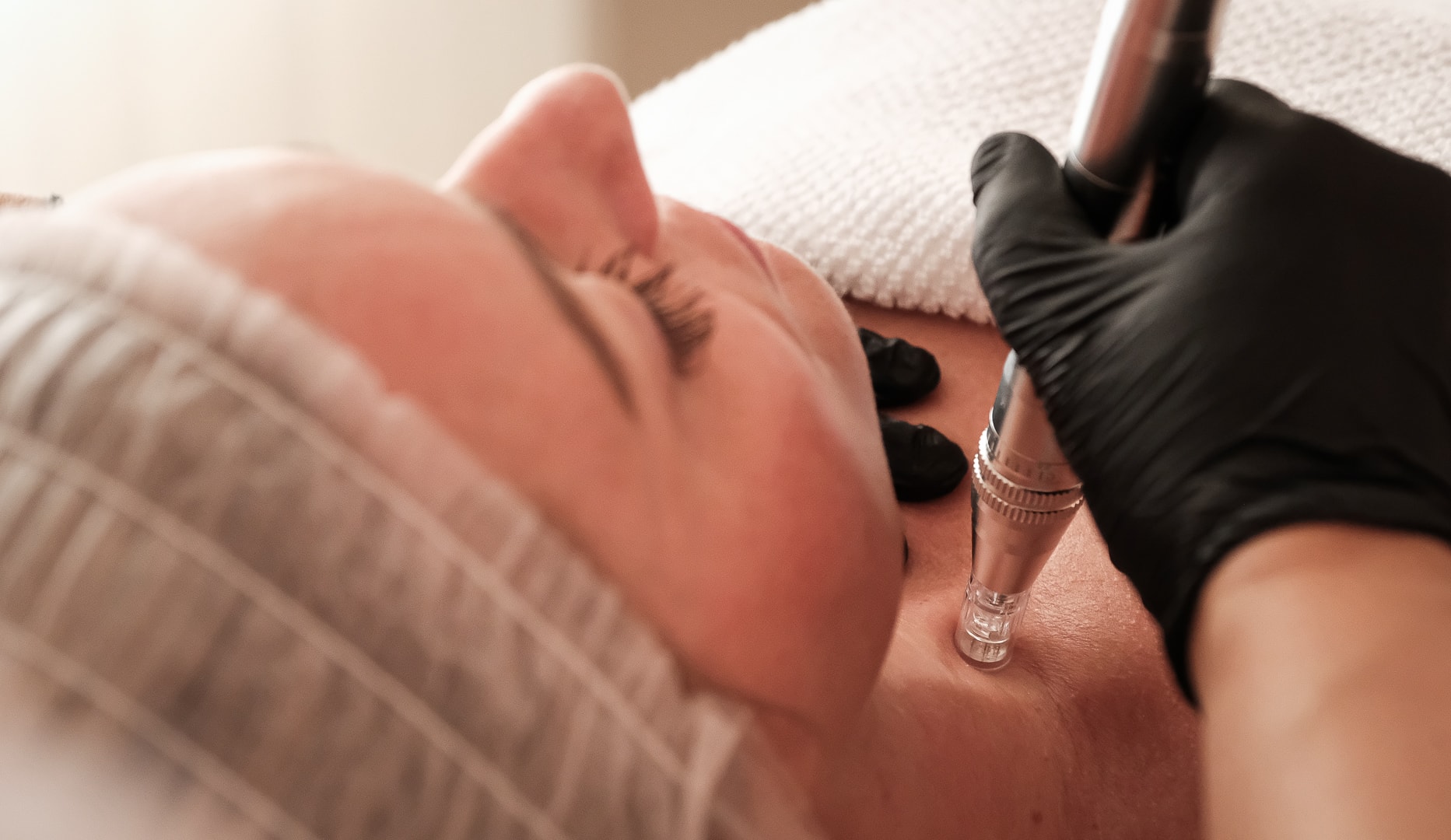Microneedling - Spar over 50 %