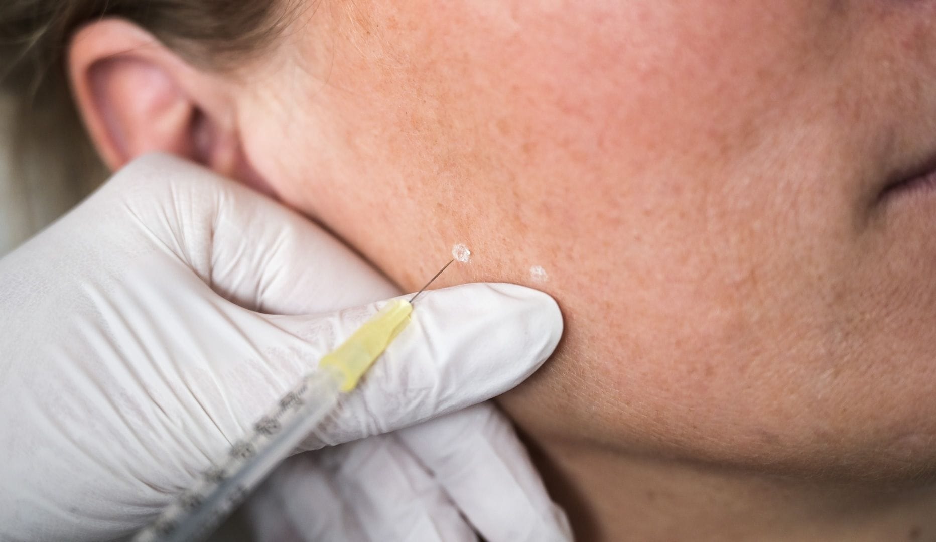 Autoriseret botox