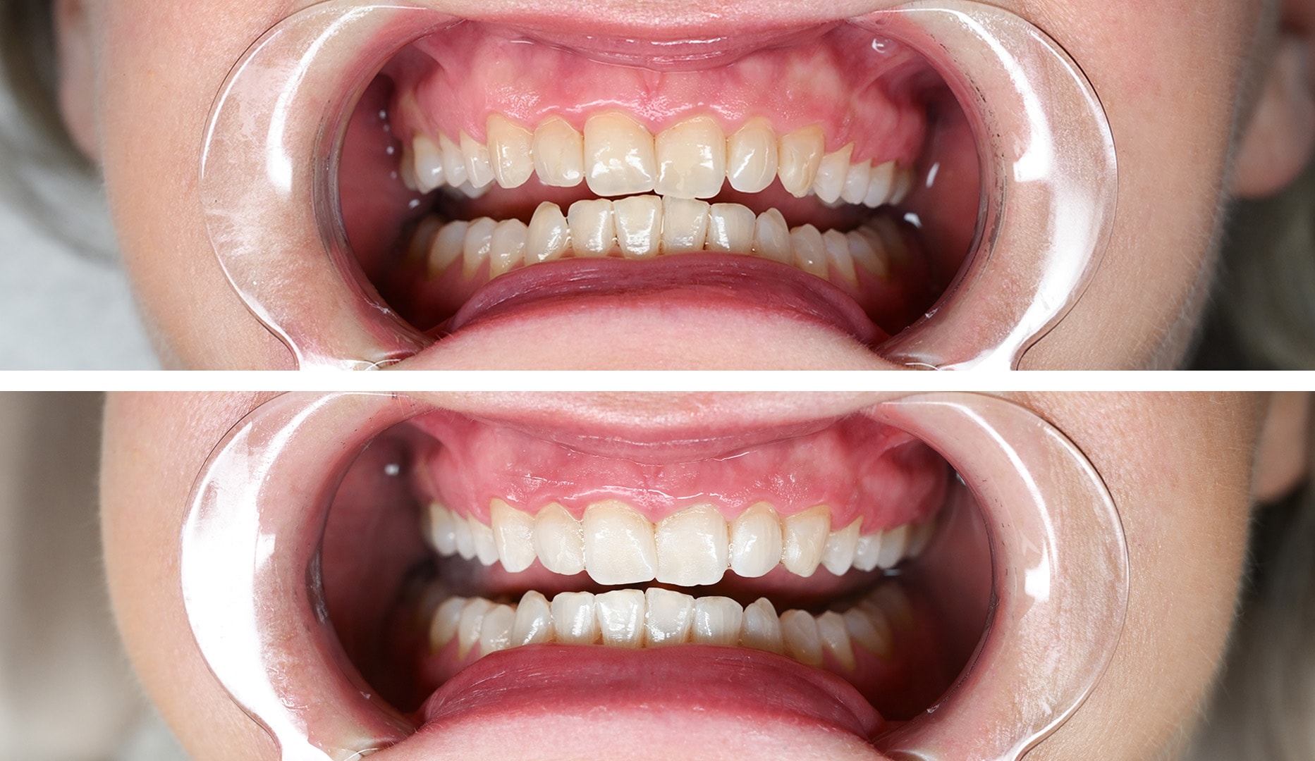 Tandblegning - Valby