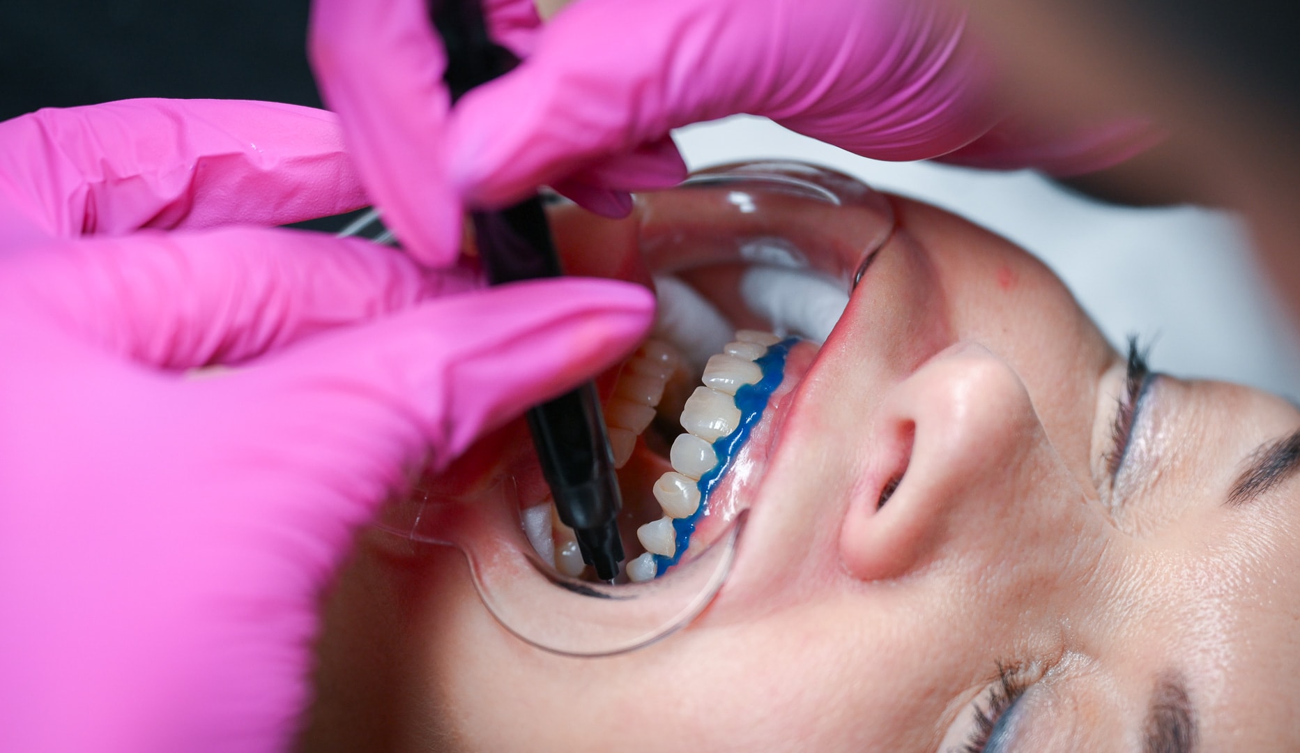 Tandblegning - Valby