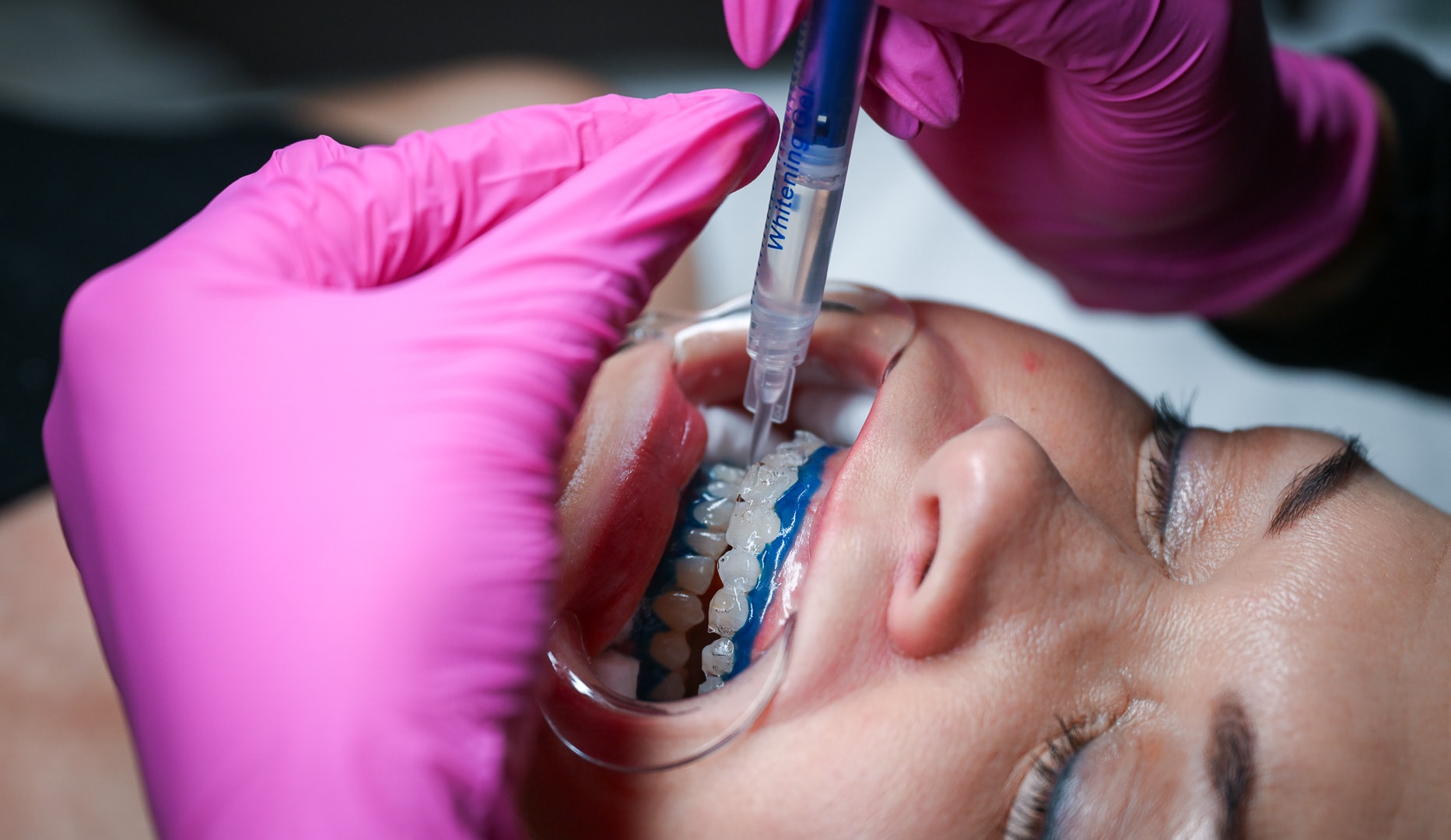 Tandblegning - Valby