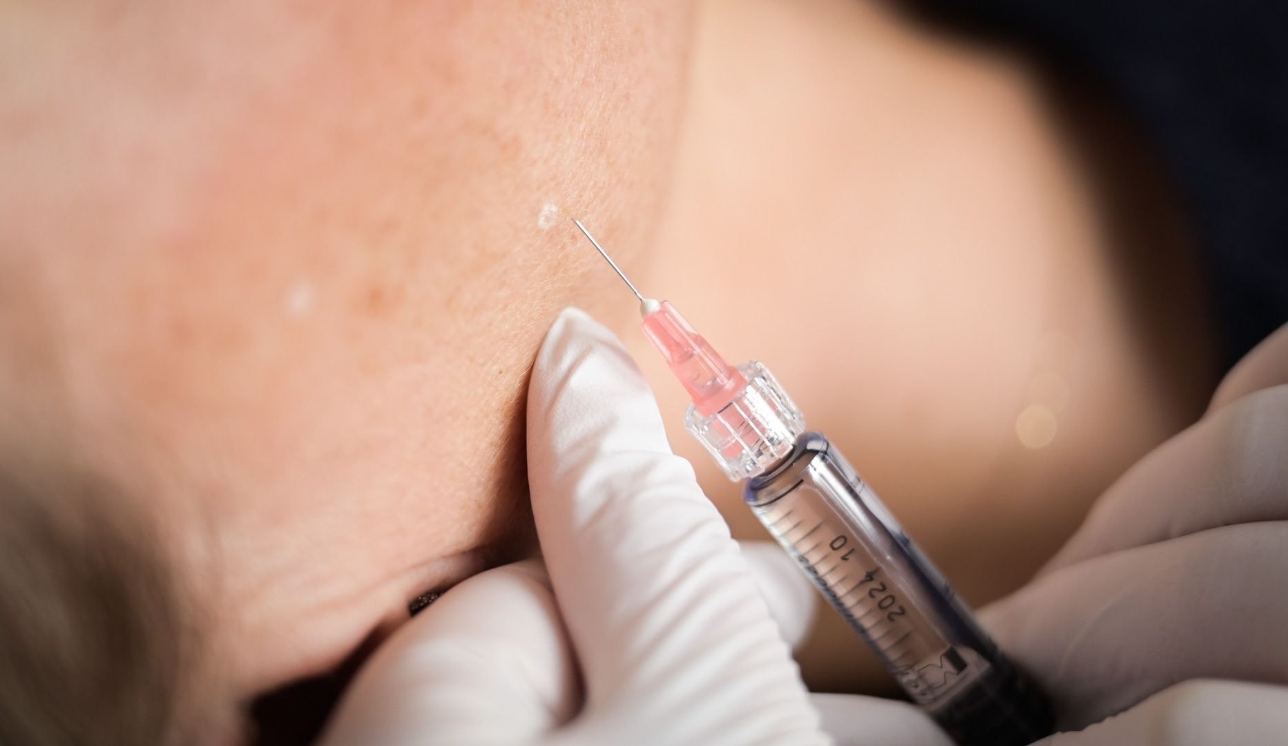 Profhilo-behandling - Lyngby