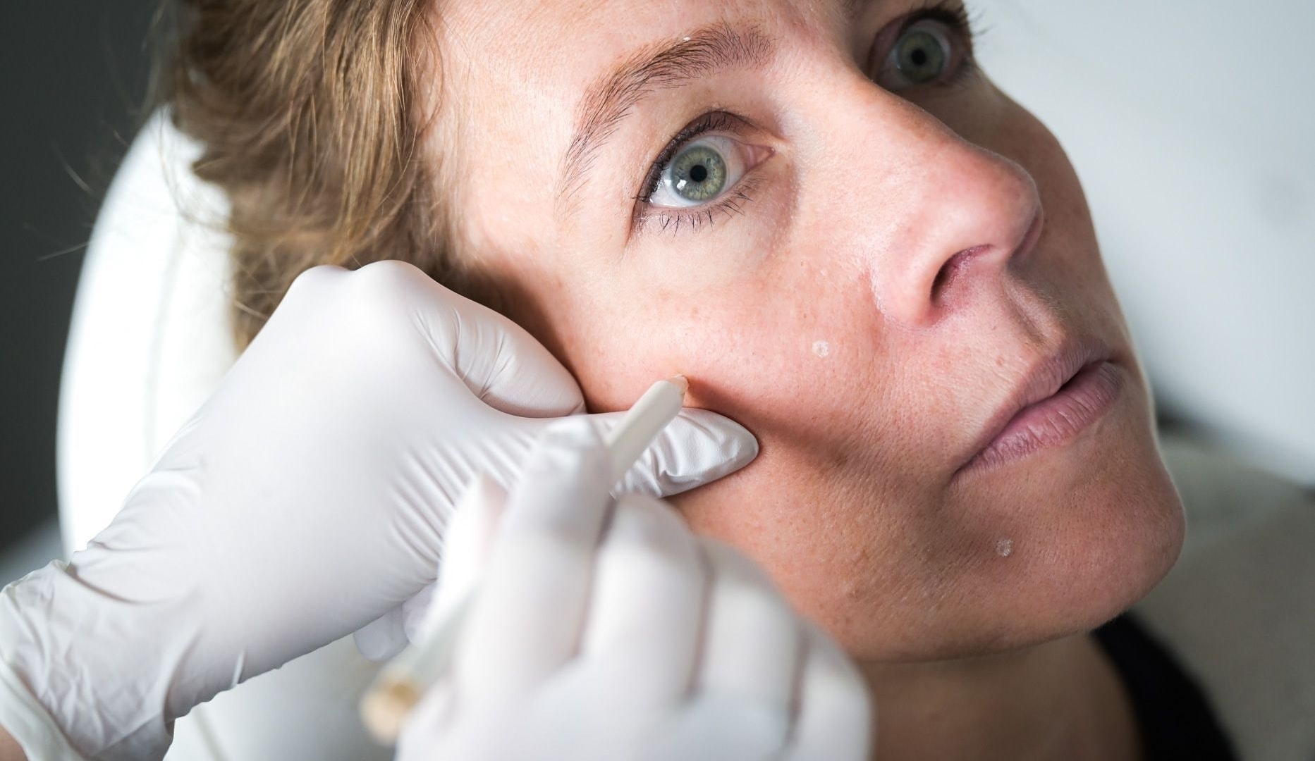 Profhilo-behandling - Lyngby