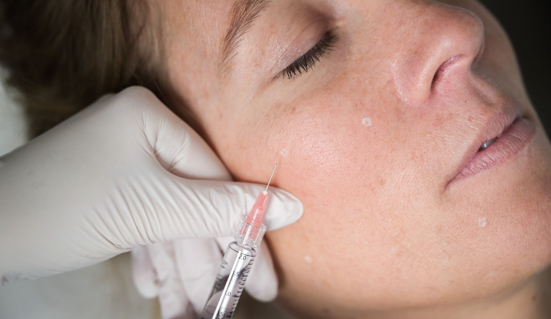 Profhilo-behandling - Lyngby