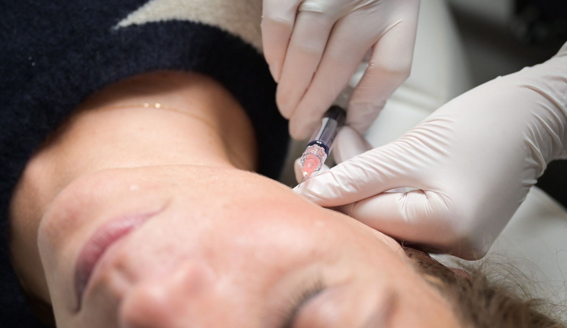 Profhilo-behandling - Lyngby