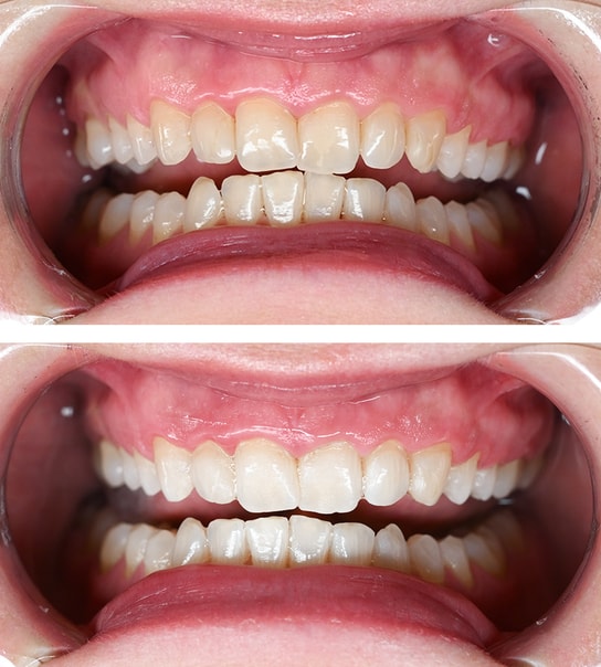 Tandblegning - Valby