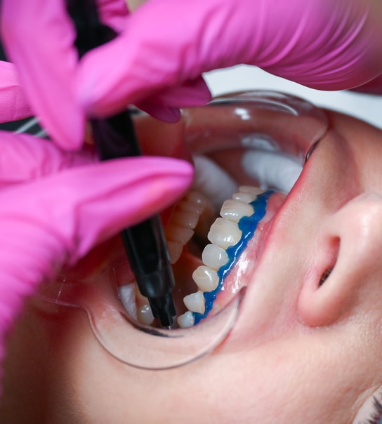 Tandblegning - Valby