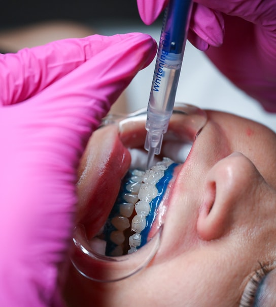 Tandblegning - Valby