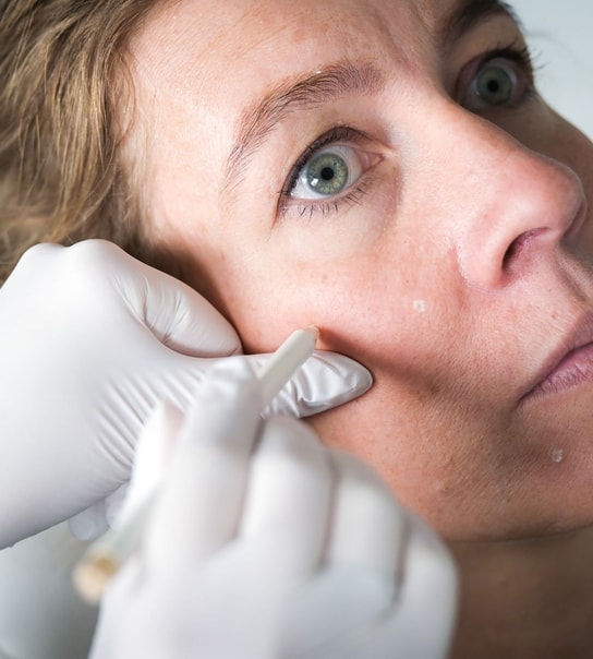 Profhilo-behandling - Lyngby