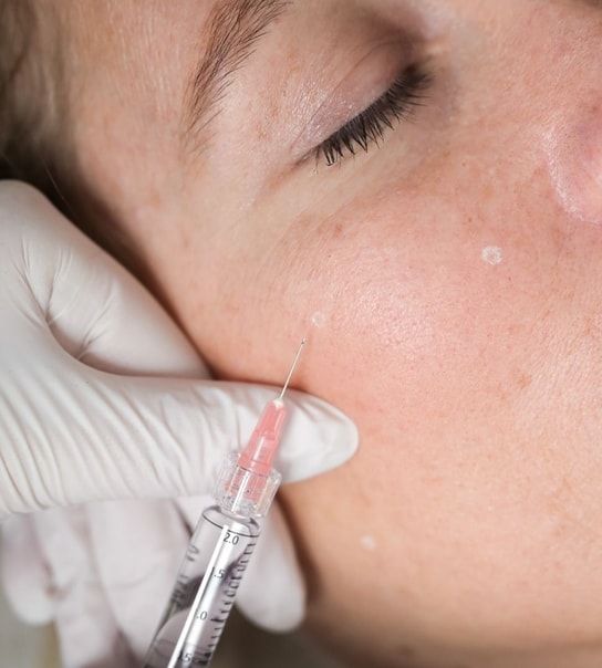 Profhilo-behandling - Lyngby