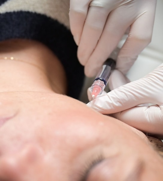 Profhilo-behandling - Lyngby